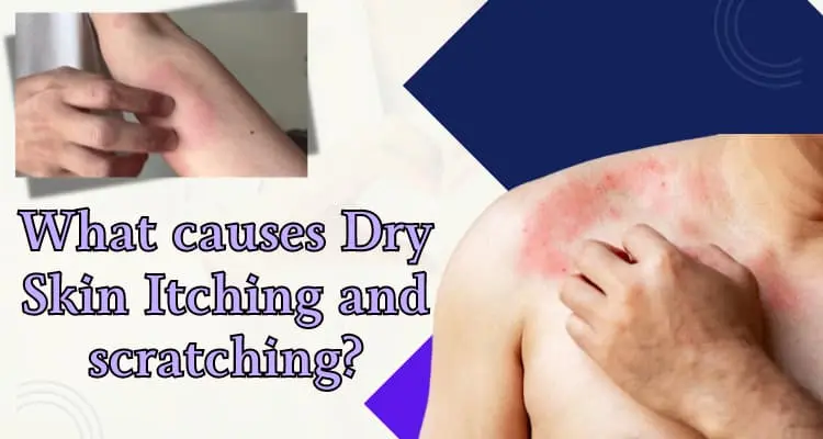 More Info; What is the Dry Skin Itching and scratching