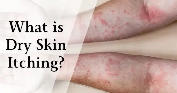 What is Dry Skin Itching