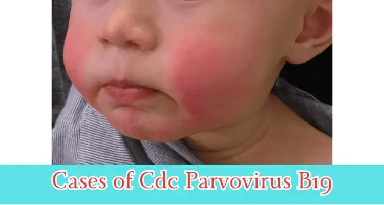 What is the cdc parvovirus b19