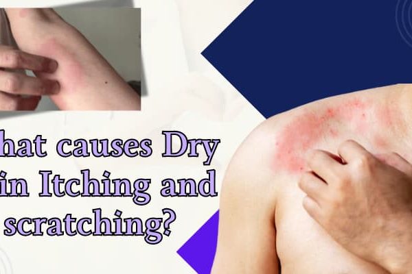 more info; What is the Dry Skin Itching and scratching