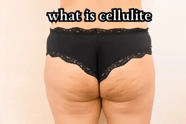 must read; what is cellulite