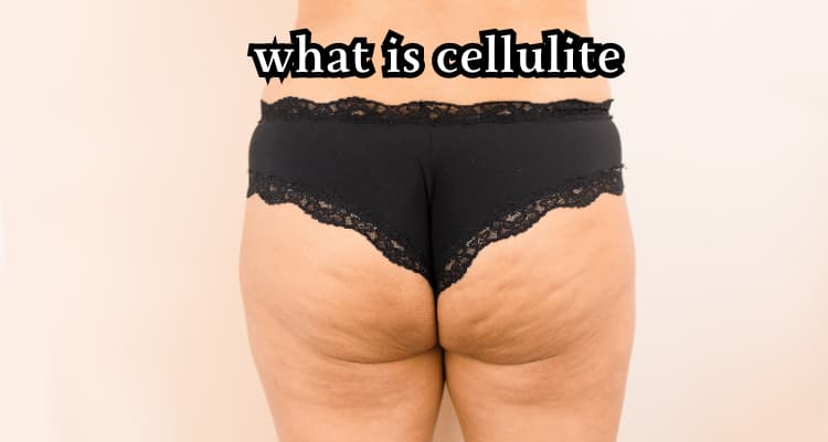 cellulite