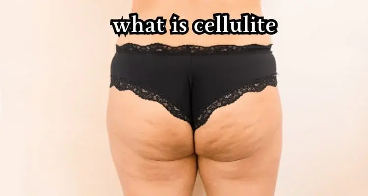 must read; what is cellulite